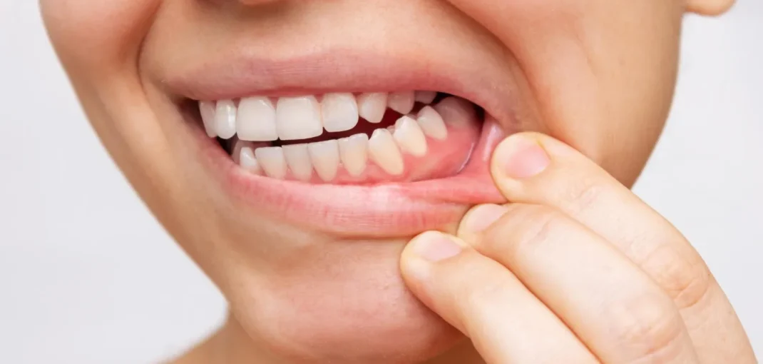 Mouthwash with Collagen: Can It Really Help Your Gums? 4 Mouthwash with Collagen Can It Really Help Your Gums